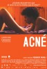 Acné